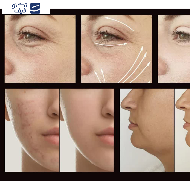 دستگاه جوانسازی هایفرکوئنسی مدل  LZ-006A دستگاه جوانسازی هایفرکوئنسی مدل  LZ-006A